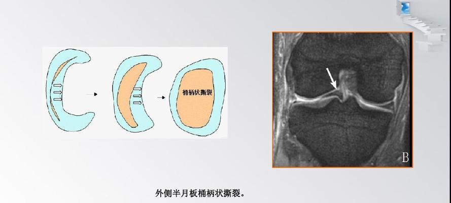 如何自测半月板损伤（有效方法帮助你判断半月板损伤程度）