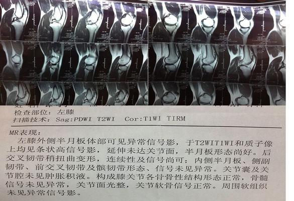 如何自测半月板损伤（有效方法帮助你判断半月板损伤程度）