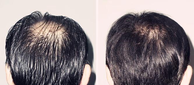 拯救稀疏头发的有效方法（恢复稀疏头发的科学护理方法）