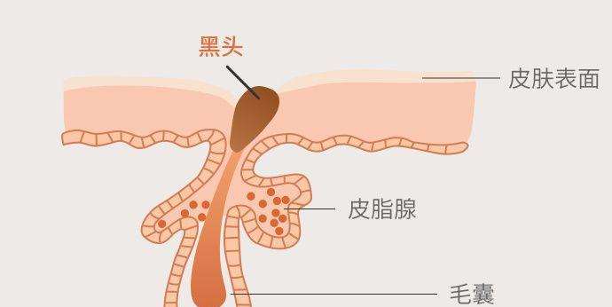 怎么快速去除鼻子上的黑头，告别烦恼？