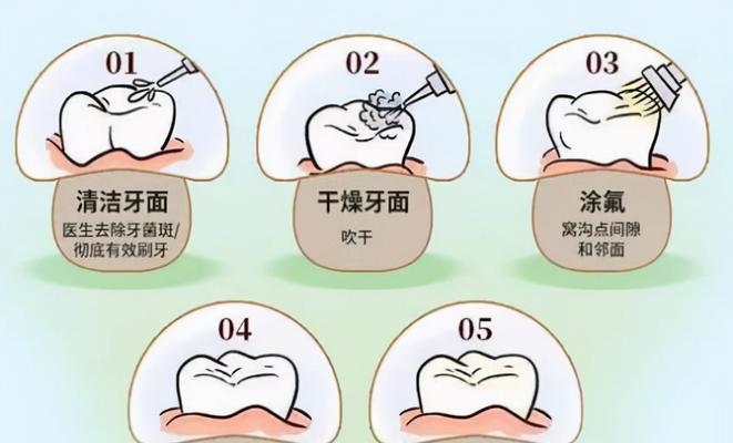 预防蛀牙，保护牙齿健康（有效方法让笑容更加迷人）